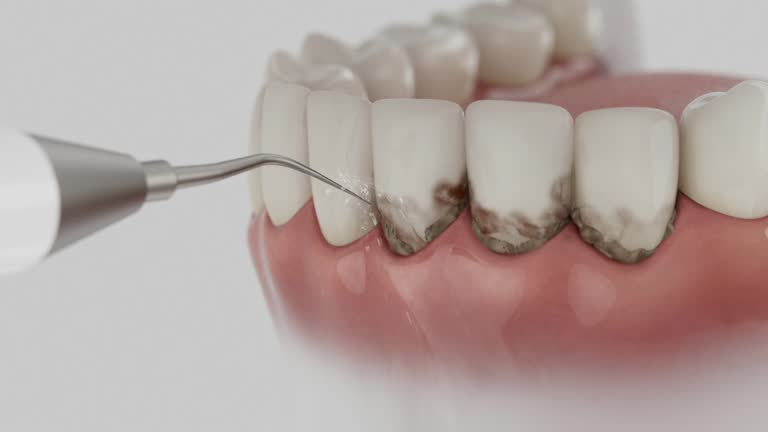 Trusted Invisalign Clear Aligners service in Bloomington, IN - Dentist Open Now